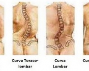 como-prevenir-a-escoliose-7