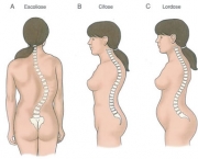 como-prevenir-a-escoliose-4