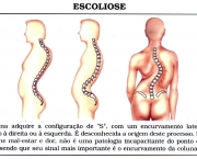 como-prevenir-a-escoliose-6