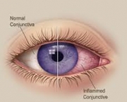 conjuntivite-1