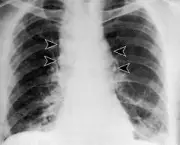 contaminacao-pulmonar-2