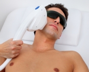 laser hair removal