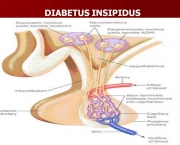 Diabetes Insipidus (5)