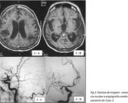 diagnostico-do-infarto-cerebral-1