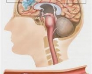 diagnostico-do-infarto-cerebral-3