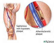 doenca-vascular-periferica-10