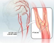 doenca-vascular-periferica-17