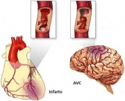 doenca-vascular-periferica-20