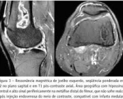 doencas-que-podem-atingir-a-medula-ossea-1