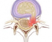 doencas-que-podem-atingir-a-medula-ossea-4