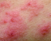 Eczemas (1)