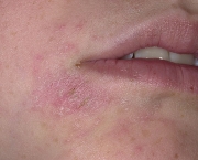 http://www.lib.uiowa.edu/hardin/md/dermnet/eczema33.html