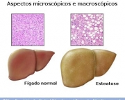 figado-inflamado-16