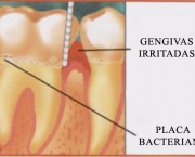 tratamento-gengivite-10