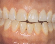 tratamento-gengivite-12