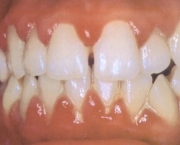 tratamento-gengivite-14