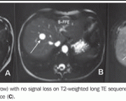 Hemangiomas No Figado (1)