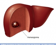 Hemangiomas No Figado (1)