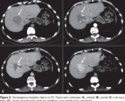 Hemangiomas No Figado (1)