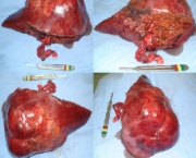 Hemangiomas No Figado (2)