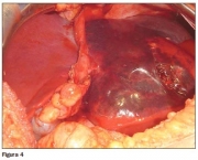 Hemangiomas No Figado (3)