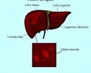 Hemangiomas No Figado (4)