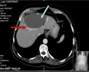 Hemangiomas No Figado (10)