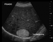 Hemangiomas No Figado (9)