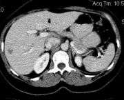 Hemangiomas No Figado (11)