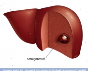 Hemangiomas No Figado (13)