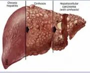 hepatite-alcoolica-e-cirrose-hepatica-4