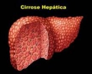 hepatite-alcoolica-e-cirrose-hepatica-5