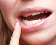 tudo-sobre-a-herpes-labial-1