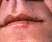 tudo-sobre-a-herpes-labial-2