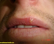 tudo-sobre-a-herpes-labial-2