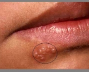 tudo-sobre-a-herpes-labial-4