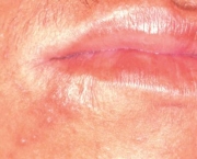 tudo-sobre-a-herpes-labial-5
