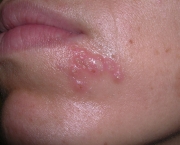 tudo-sobre-a-herpes-labial-6