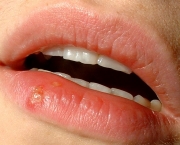tudo-sobre-a-herpes-labial-7