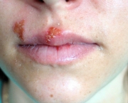tudo-sobre-a-herpes-labial-9