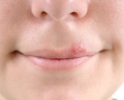 tudo-sobre-a-herpes-labial-12
