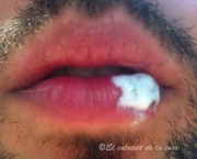 tudo-sobre-a-herpes-labial-14