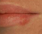tudo-sobre-a-herpes-labial-15