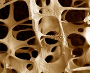 hipertensao-osteoporose-e-sindrome-de-wernicke-korsakoff-3