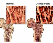 hipertensao-osteoporose-e-sindrome-de-wernicke-korsakoff-4