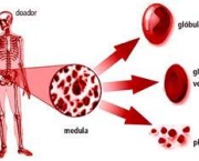 leucemia-no-sangue-1
