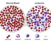 leucemia-no-sangue-10