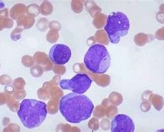 leucemia-no-sangue-12