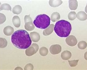 leucemia-no-sangue-3