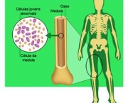 leucemia-no-sangue-5